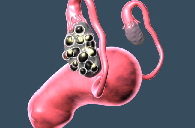 what-is-polycystic-ovary-syndrome