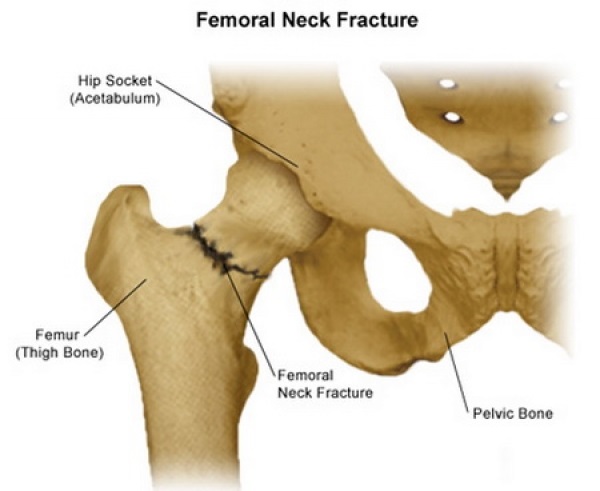 Femoral Neck Fracture Diagnosis