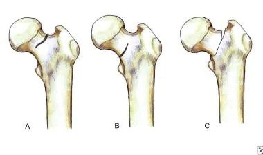 Femoral Neck Fracture