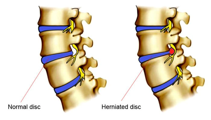 normal vs. herniated disc