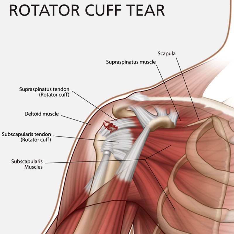 rotator cuff tearRotator Cuff Surgery