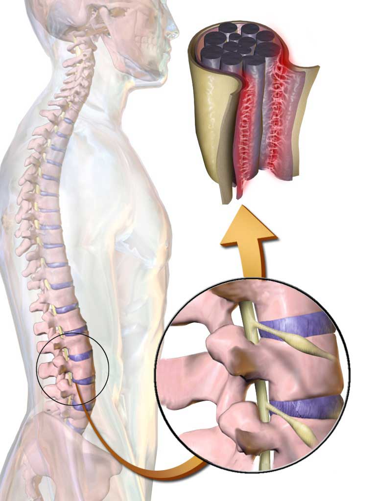 What is an Arachnoid? 