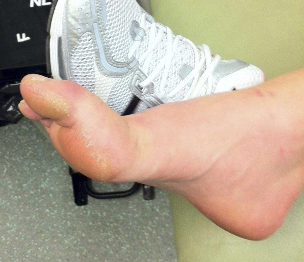 Big Toe Sprain: Turf Toe