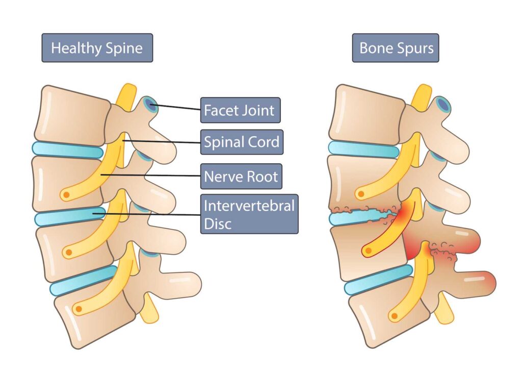 Difference Between Healthy Spine and Bone Spurs