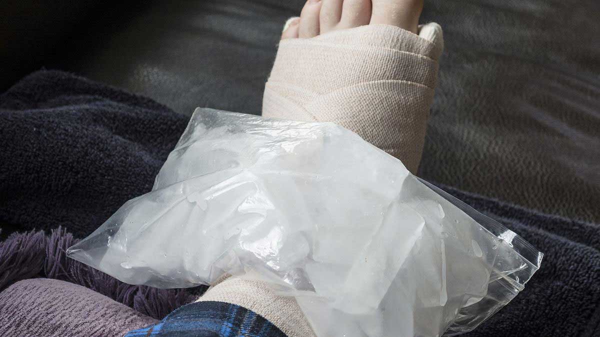 Ice Pack Therapy for Stress Fracture