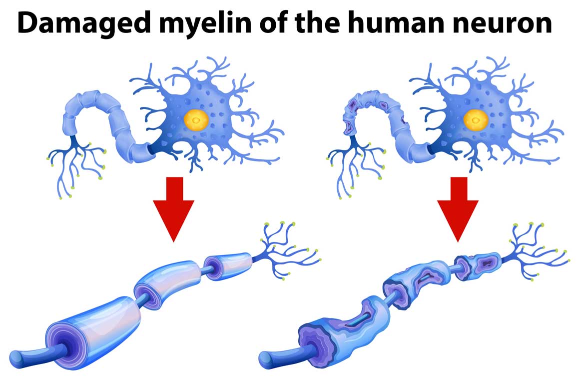 Reason of Nerve Pain