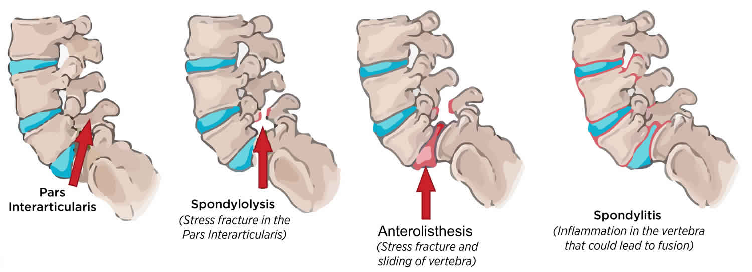 Cause of Anterolisthesis