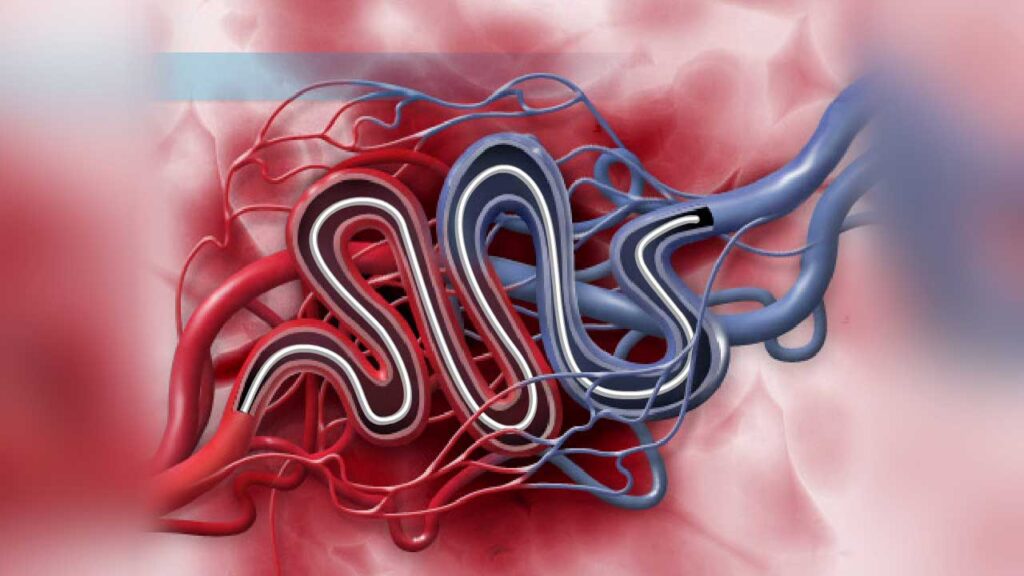 Spinal arteriovenous malformation