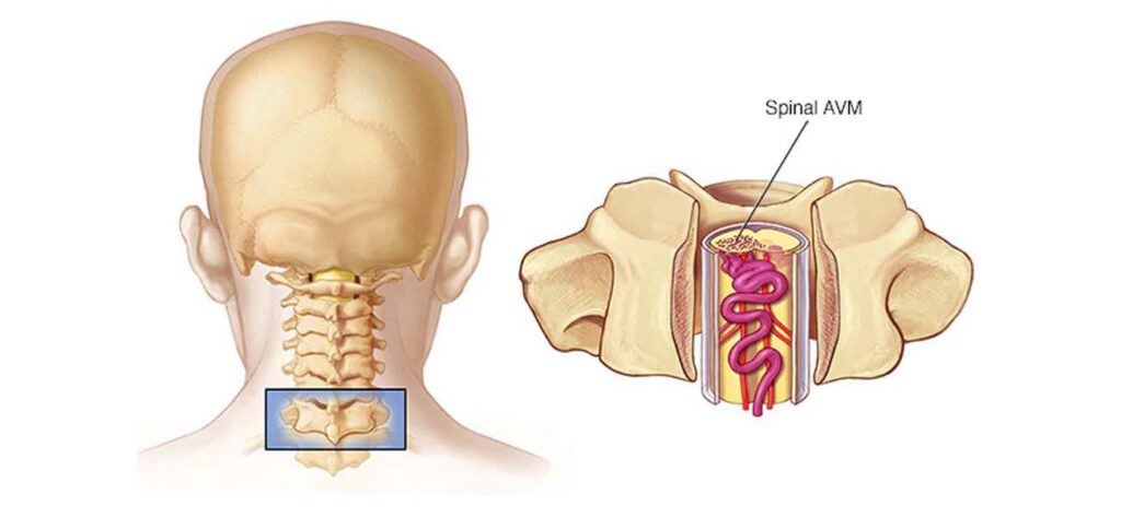 Symptoms Of Spinal Arteriovenous Malformation