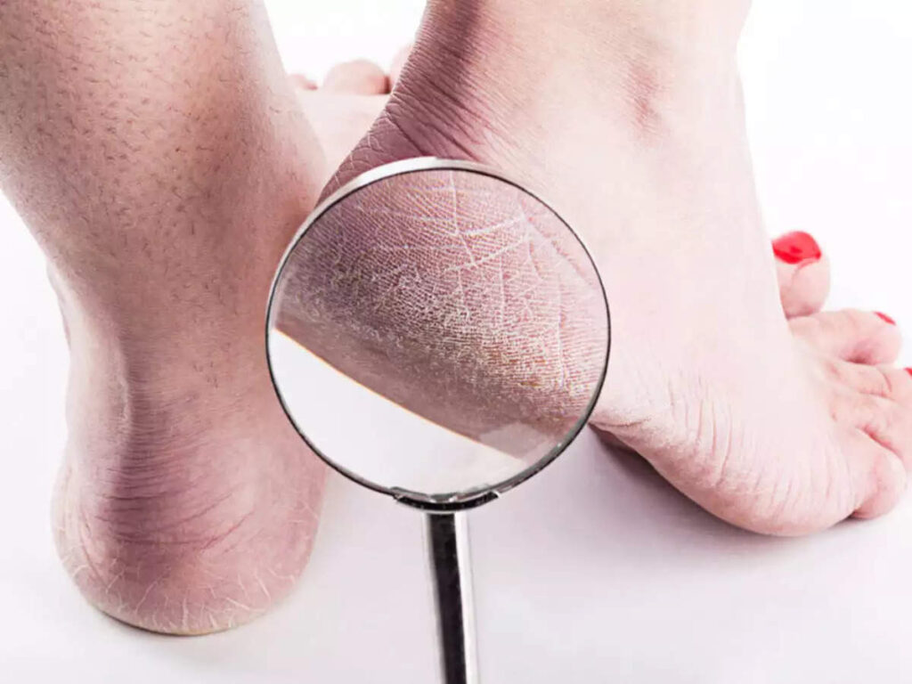 Sign and Symptoms of Cracked Heels