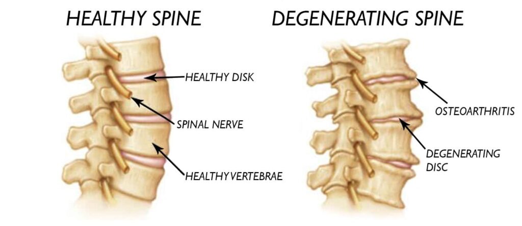 Chiropractic Treatment For Degenerative Disc Disease 