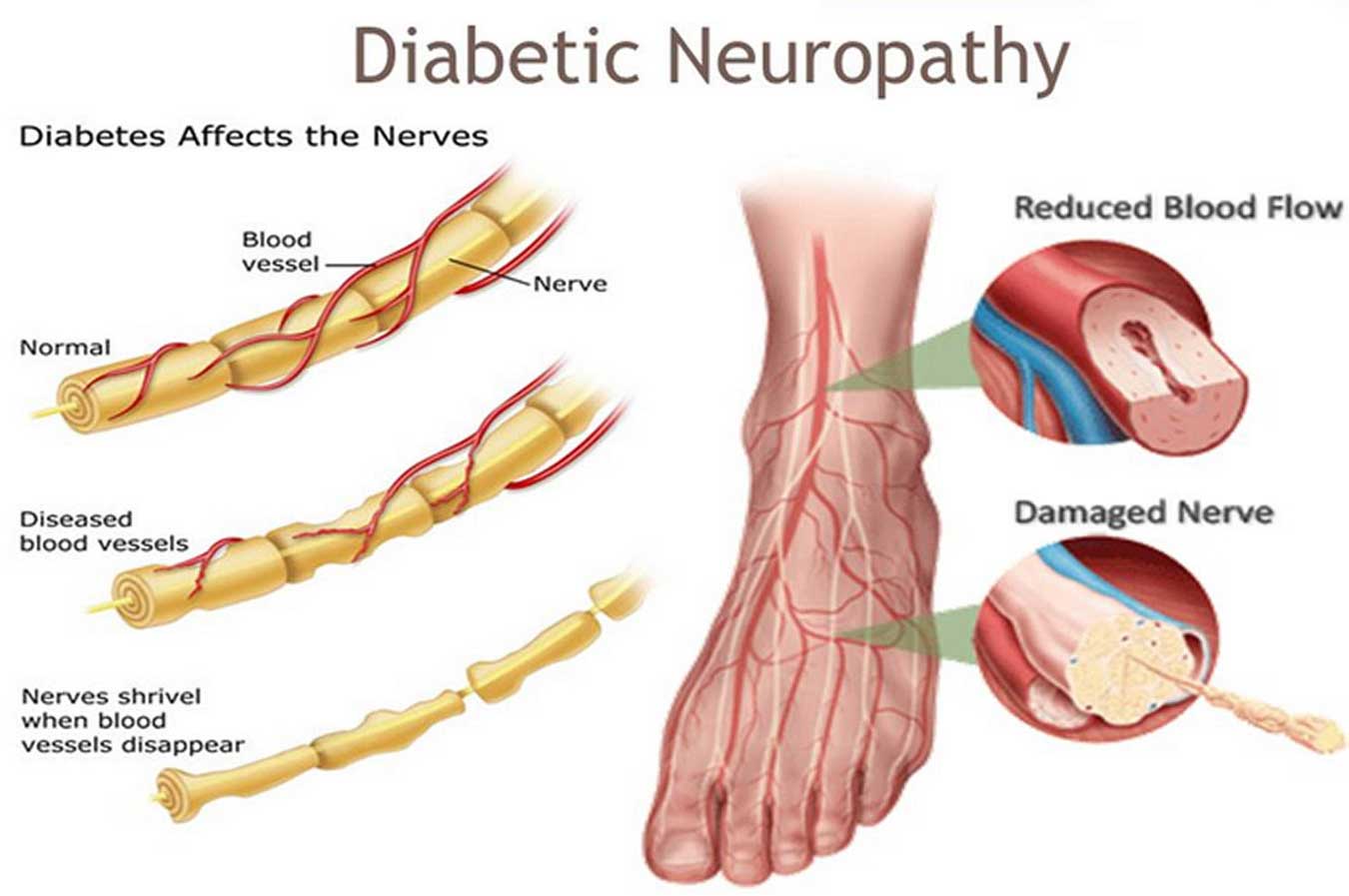 Diabetic Neuropathy