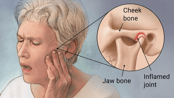 temporomandibular joint disorder