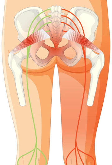 sciatica treatment