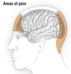 Areas of pain