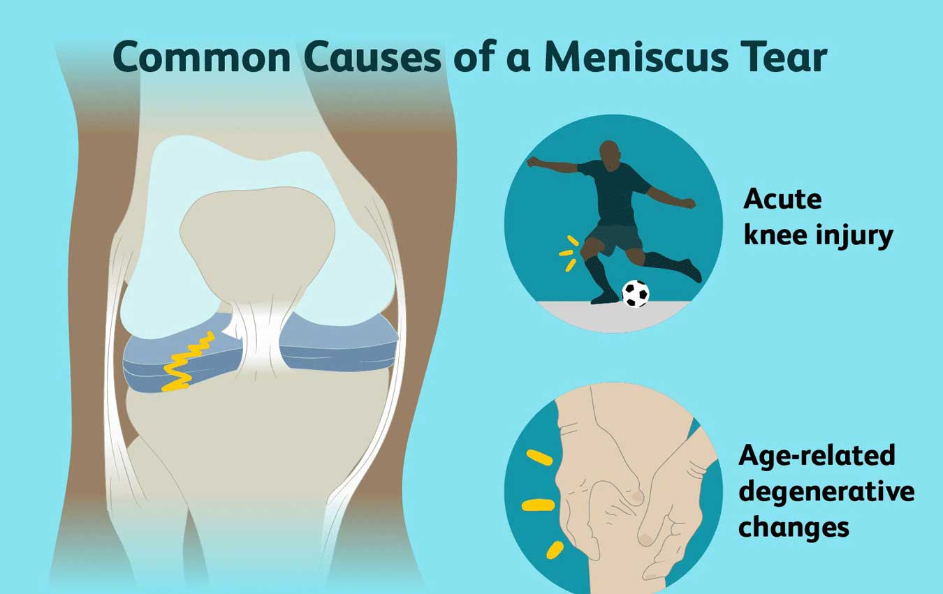 Common Causes of a Meniscus Tear