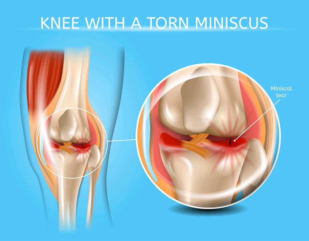 Knee with A Torn Miniscus