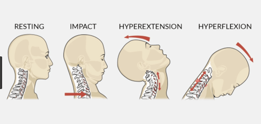 neck sprain