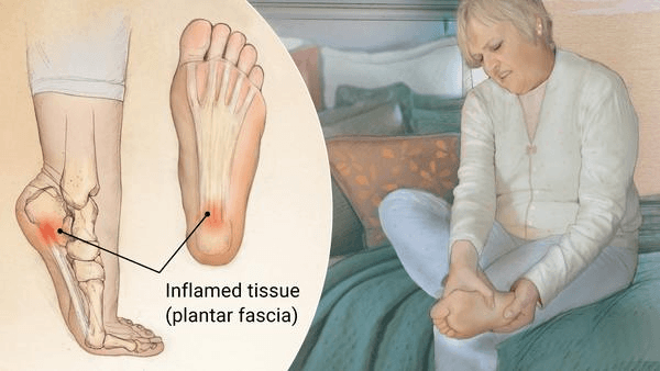 inflamed tissue in foot