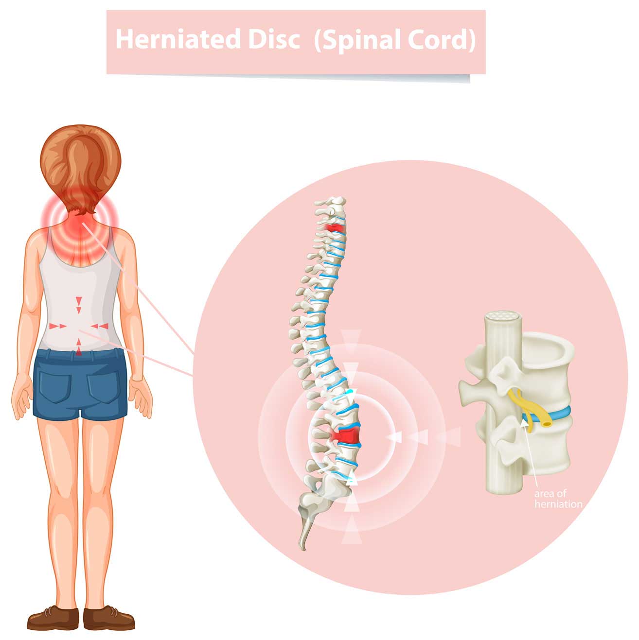 Causes of Coccydynia