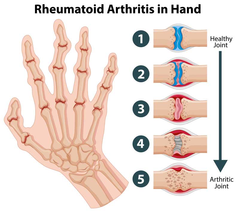 Rheumatoid Arthritis In a Hand