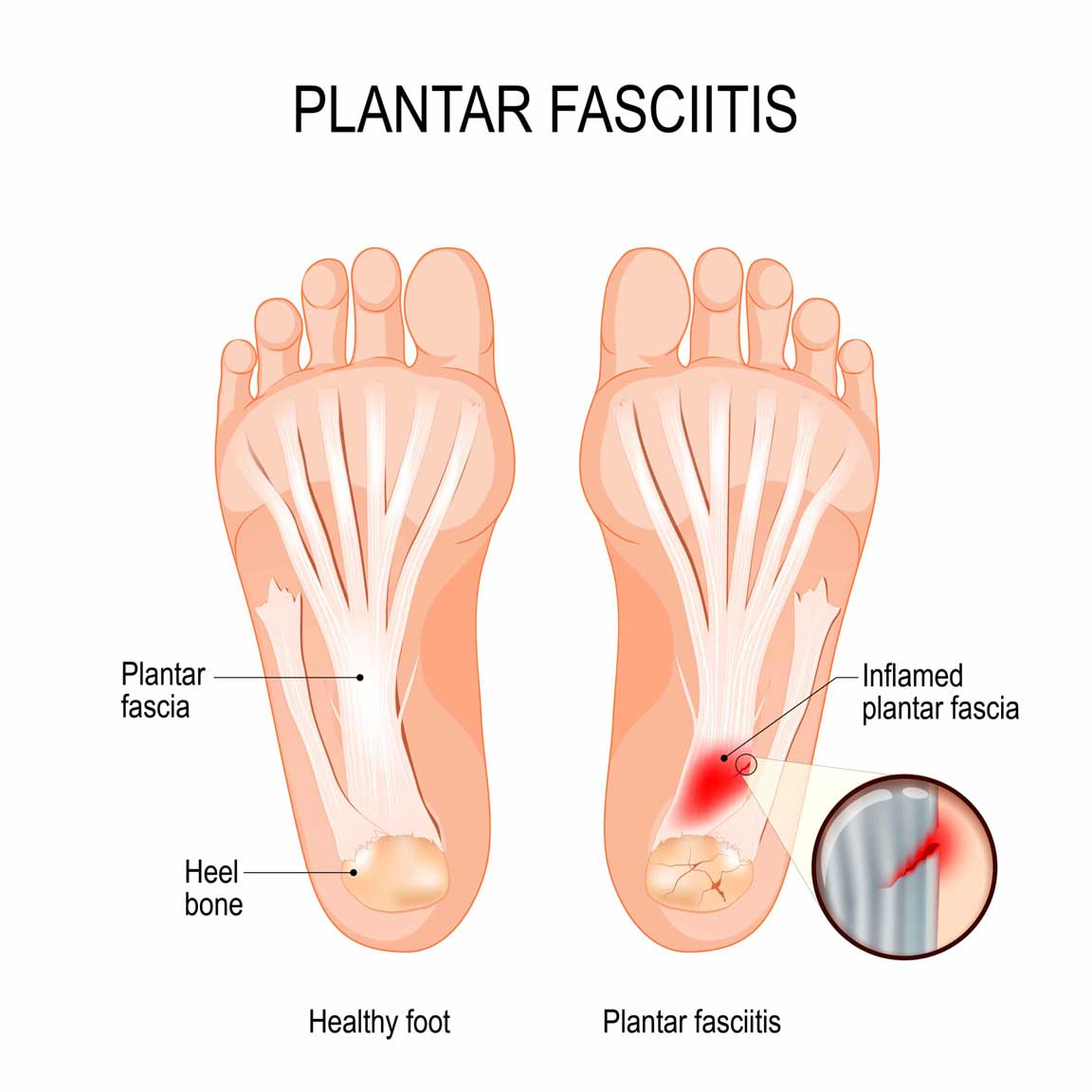 What Is Plantar Fasciitis