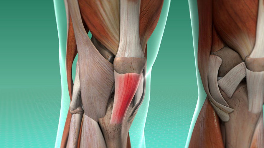 Posterior Cruciate Ligament Injury Symptoms