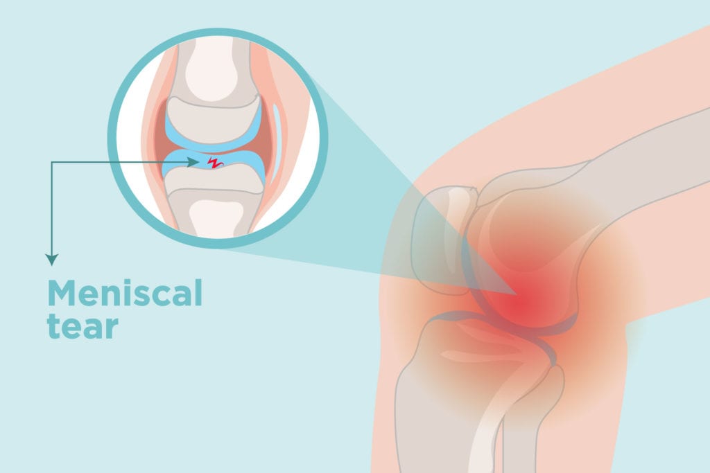 torn meniscus pain area