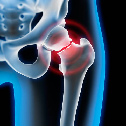 Femoral Neck Fracture Treatment