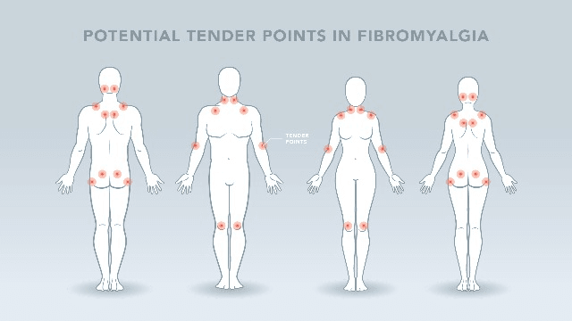 tender points in fibromyalgia