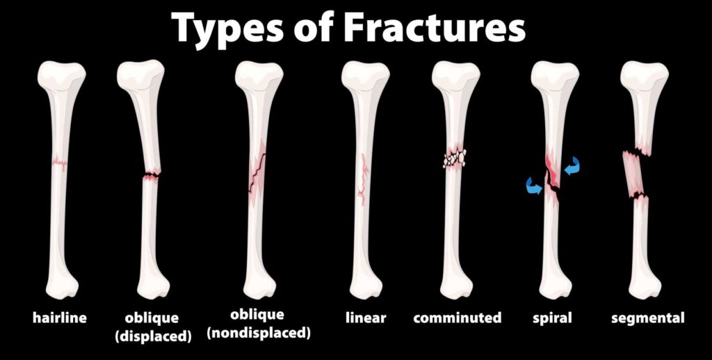 Types Hairline Fracture