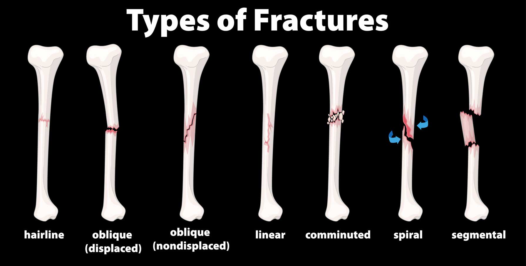 causes-symptoms-and-treatment-for-hairline-fracture-zenith-injury