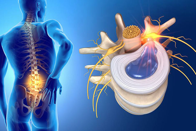 herniated disc