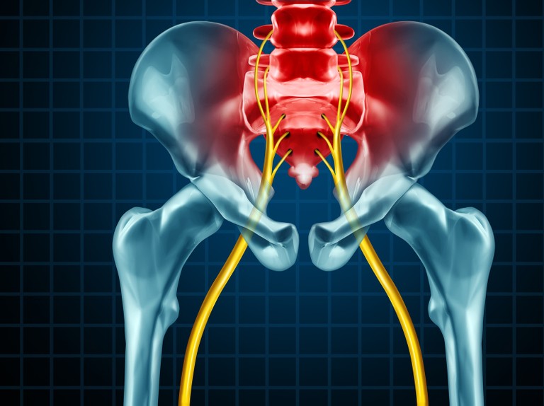 Painful Sciatic Nerve