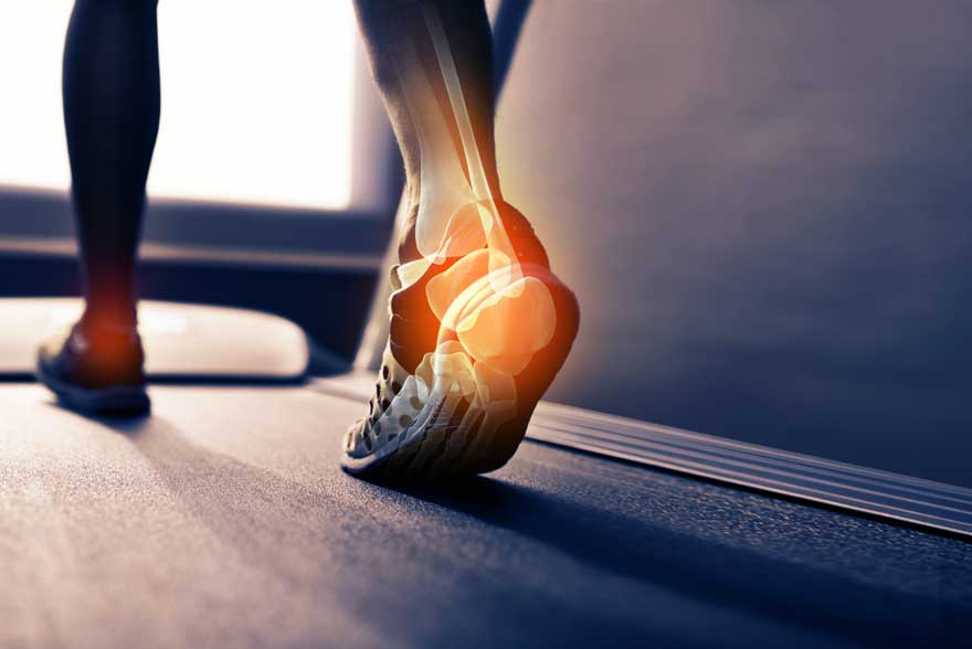 WHAT IS PLANTAR FASCIITIS?