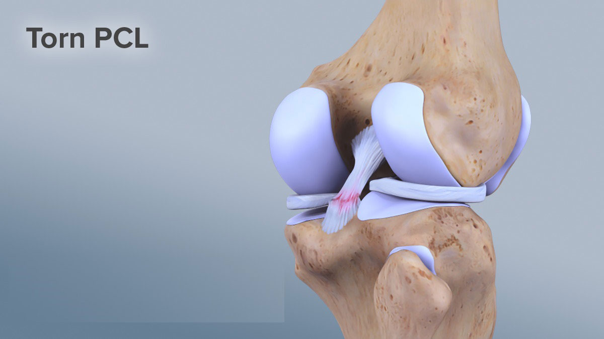 Posterior Cruciate Ligament Tear